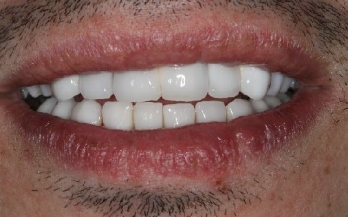 После реабилитации