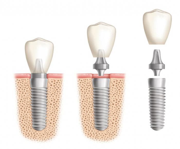 Процесс установки зубных имплантантов